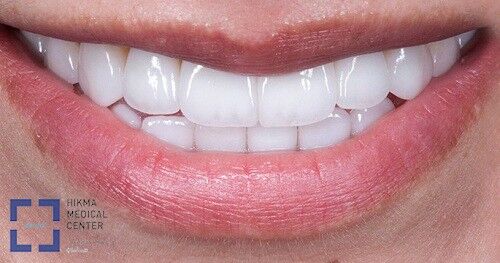 The Truth About Teeth Whitening Products